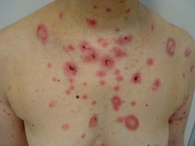 Sắp có thuốc điều trị bệnh nan y lupus ban đỏ 